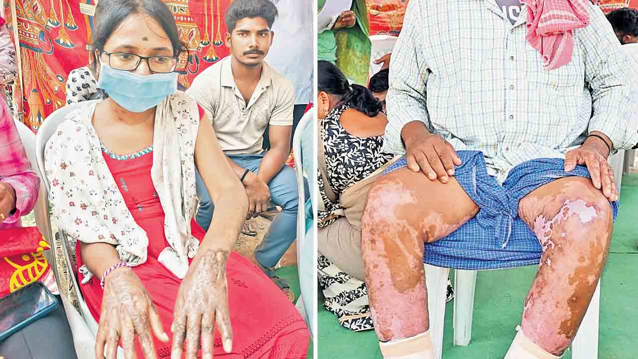 సిగాచి బాధితులకు అండగా బీఆర్‌ఎస్‌