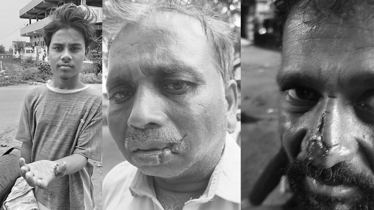 Dog Attack | పిచ్చికుక్క దాడిలో ఐదుగురికి తీవ్ర గాయాలు.. హైదరాబాద్‌కు తరలింపు