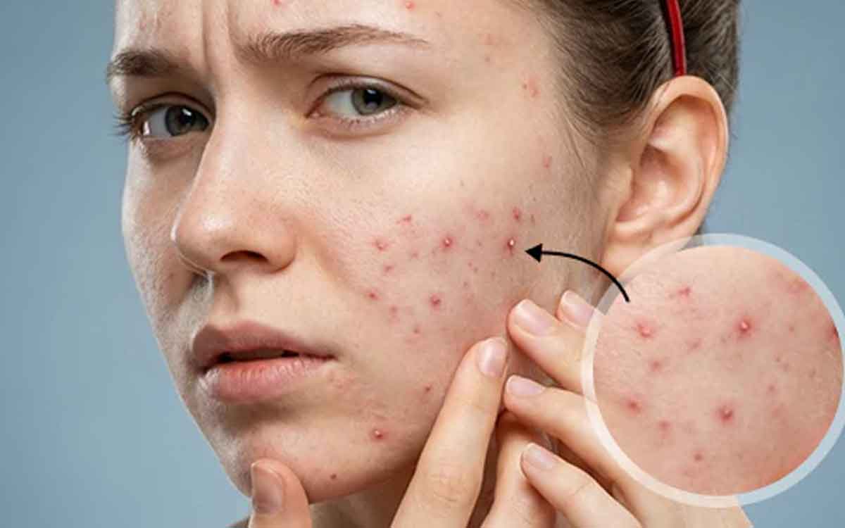 Acne | మొటిమ‌లు అధికంగా ఏర్ప‌డుతున్నాయా.. అందుకు కార‌ణాలు ఇవే.. ఏం చేయాలంటే..?