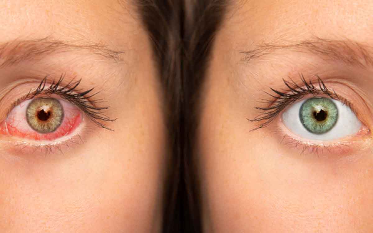 Dry Eyes | అధిక‌మ‌వుతున్న క‌ళ్లు పొడిబారే స‌మ‌స్య.. జాగ్ర‌త్త‌లు సూచిస్తున్న నిపుణులు..