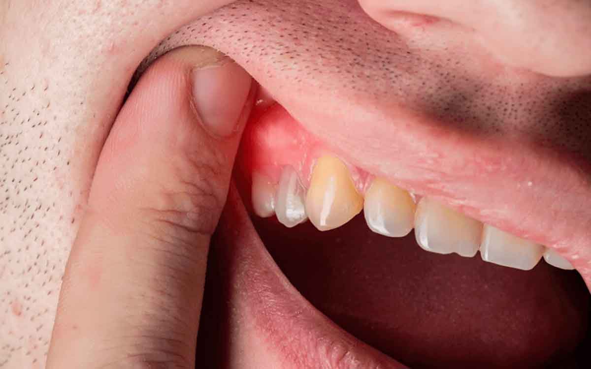 Gums Health | చిగుళ్ల వాపు, ర‌క్త‌స్రావం స‌మ‌స్య‌ల‌కు అస‌లు కార‌ణం ఏంటి.. త‌గ్గాలంటే ఏం చేయాలి..?