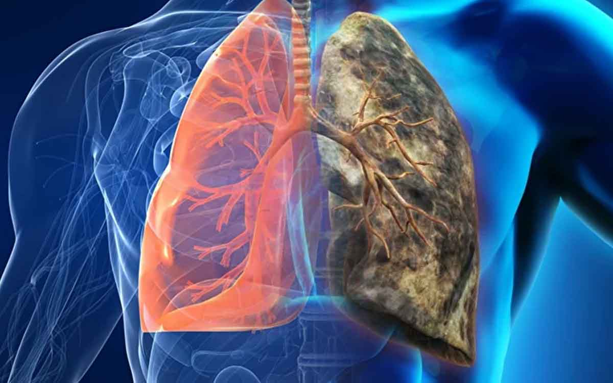 Smoking | రోజూ కాకుండా అప్పుడ‌ప్పుడు పొగ తాగినా న‌ష్ట‌మే.. ఏమీ కాద‌ని అనుకోవ‌ద్దు.. వైద్యుల హెచ్చ‌రిక‌..