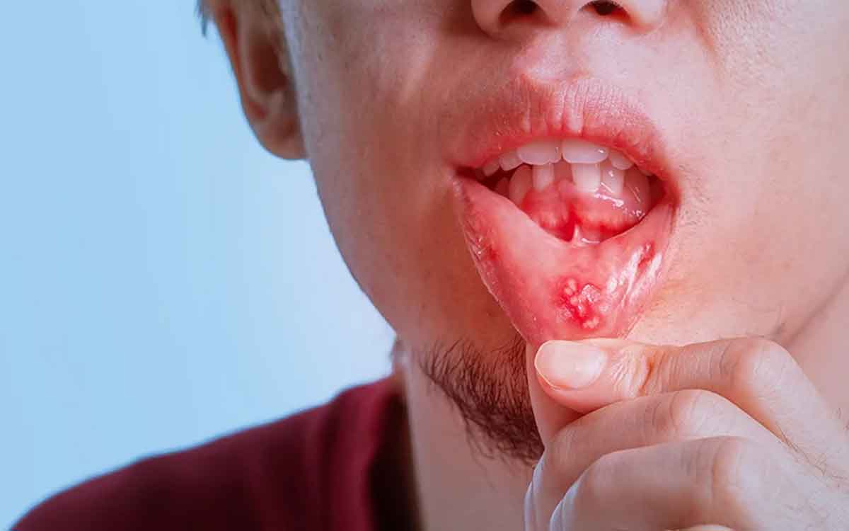 Oral Cancer | నోటి క్యాన్స‌ర్ వ‌చ్చేందుకు ధూమ‌పానం ఒక్క‌టే కాదు, ఇవి కూడా కార‌ణాలే.. ఎలా గుర్తించాలంటే..