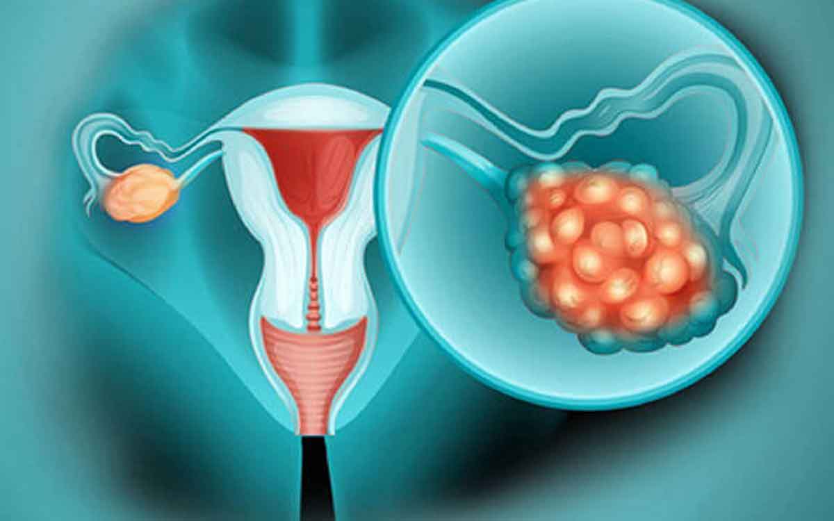 Ovarian Cancer | అండాశ‌య క్యాన్స‌ర్ చికిత్స‌లో ప‌రిశోధ‌కుల ప్ర‌గ‌తి.. నూత‌న ఔష‌ధంతో జీవ‌న‌కాలం పెంపు..
