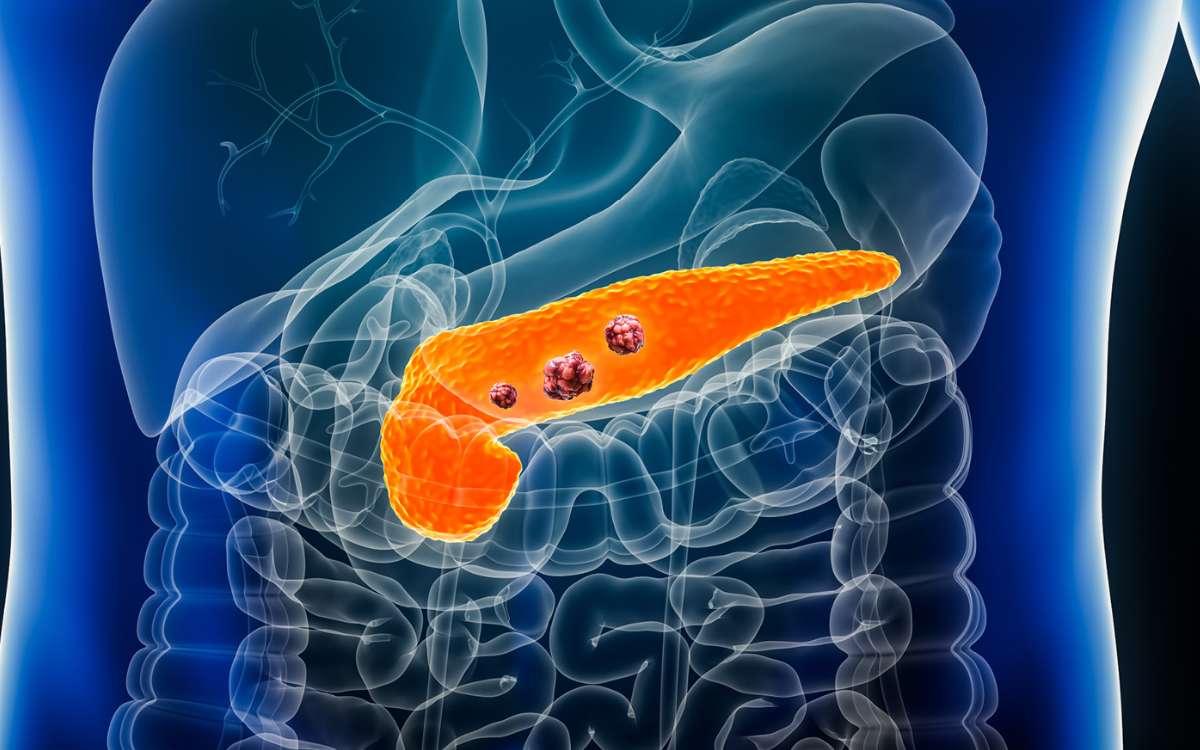 Pancreatic Cancer | పాంక్రియాటిక్ క్యాన్స‌ర్ చికిత్స‌లో కొత్త అడుగు.. నూత‌న ఔష‌ధంతో రెట్టింపైన జీవ‌న కాలం..