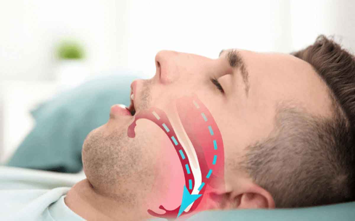Sleep Apnea | ఈ సాధార‌ణ వ్యాయామాలు చేస్తే స్లీప్ అప్నియాకు చెక్ పెట్ట‌వ‌చ్చు..