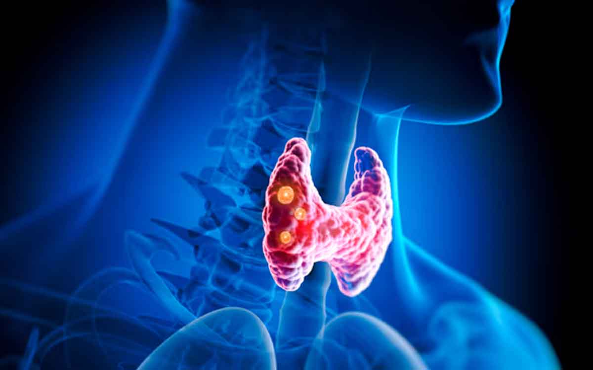 Hypothyroidism | హైపో థైరాయిడిజం ఉన్న‌వారు పాటించాల్సిన డైట్ ఇదే.. దీంతో అనేక స‌మ‌స్య‌లు త‌గ్గుతాయి..