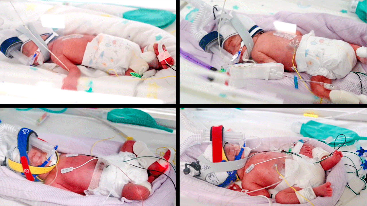 Quadruplet Girls | ఒకే కాన్పులో న‌లుగురు ఆడ‌పిల్ల‌ల‌కు జ‌న్మ‌నిచ్చిన మ‌హిళ‌.. ఇప్ప‌టికే ముగ్గురు పిల్ల‌లు..!