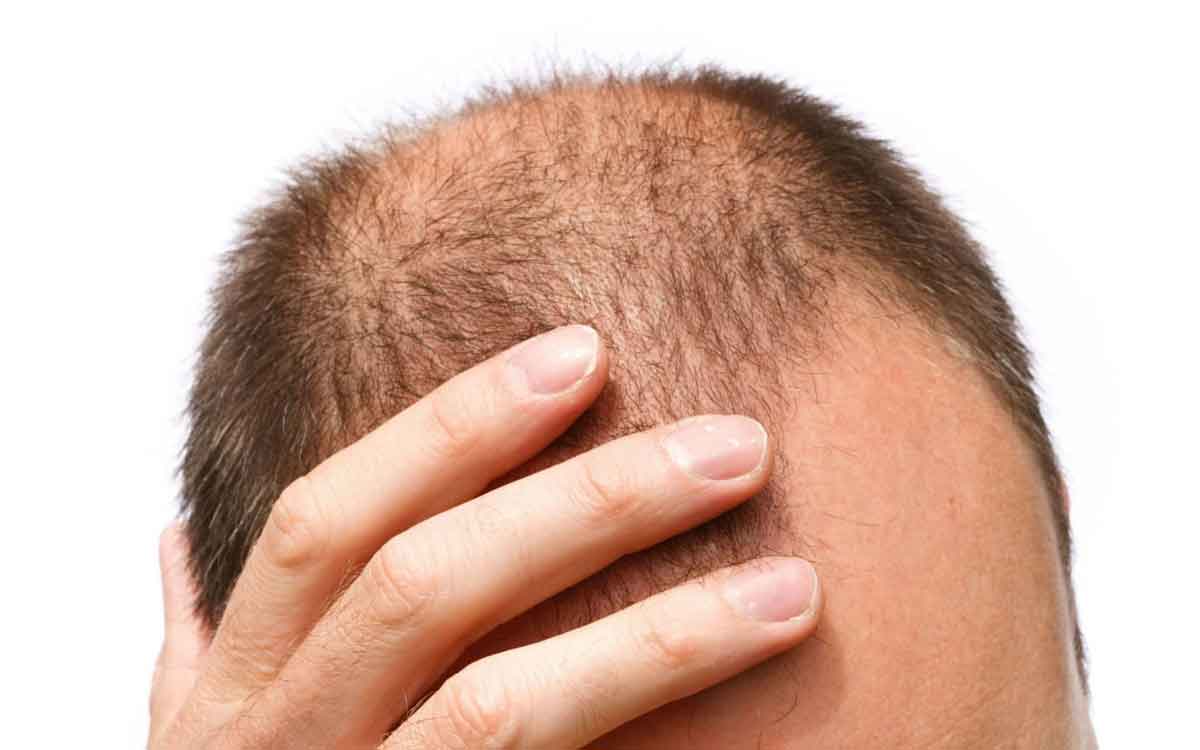 Hair | జుట్టు రాల‌డాన్ని స్వీక‌రిస్తూ గుండుతో ఉండేందుకే ప్రాధాన్య‌త ఇస్తున్న యువ‌త‌.. మారుతున్న ట్రెండ్‌..