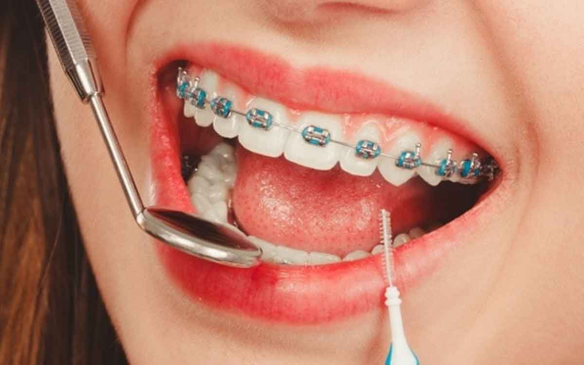 Braces | దంత స‌మ‌స్య‌ల‌కు కేవ‌లం పిల్ల‌ల‌కే బ్రేసెస్ చికిత్స చేస్తారా.. పెద్ద‌ల‌కు చేయ‌వ‌చ్చా..?