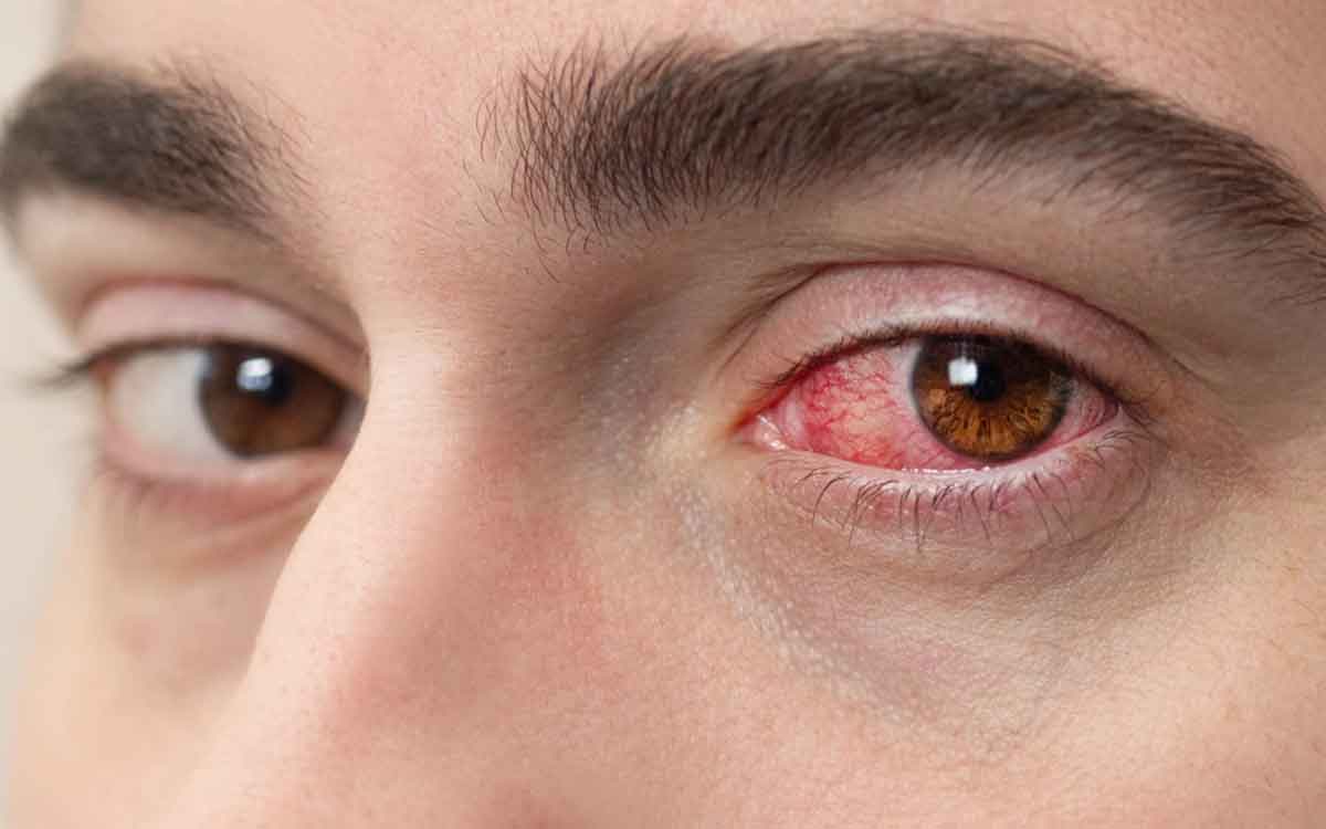 Conjunctivitis | ఈ సీజ‌న్‌లో కంజంక్టివైటిస్ ప‌ట్ల జాగ్ర‌త్త‌గా ఉండాల్సిందే.. అస‌లేంటిది.. ఎలా వస్తుంది..?