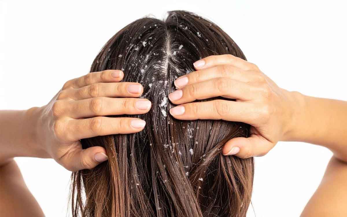 Dandruff | చుండ్రు అస‌లు ఎందుకు వ‌స్తుంది.. ఈ ఒక్క ప‌దార్థంతో స‌మ‌స్య‌కు చెక్ పెట్ట‌వ‌చ్చు..