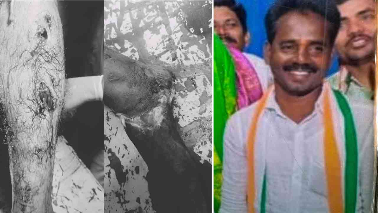 కాంగ్రెస్ నేతల అరాచకం.. మక్తల్‌లో బీఆర్ఎస్ నాయకుడిపై దాడి