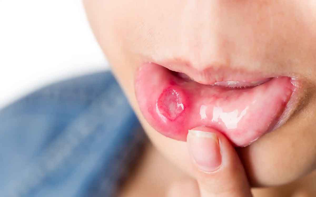 Mouth Ulcers | నోటి పూత‌లు అస‌లు ఎందుకు వస్తాయి.. త‌గ్గాలంటే ఏం చేయాలి..?