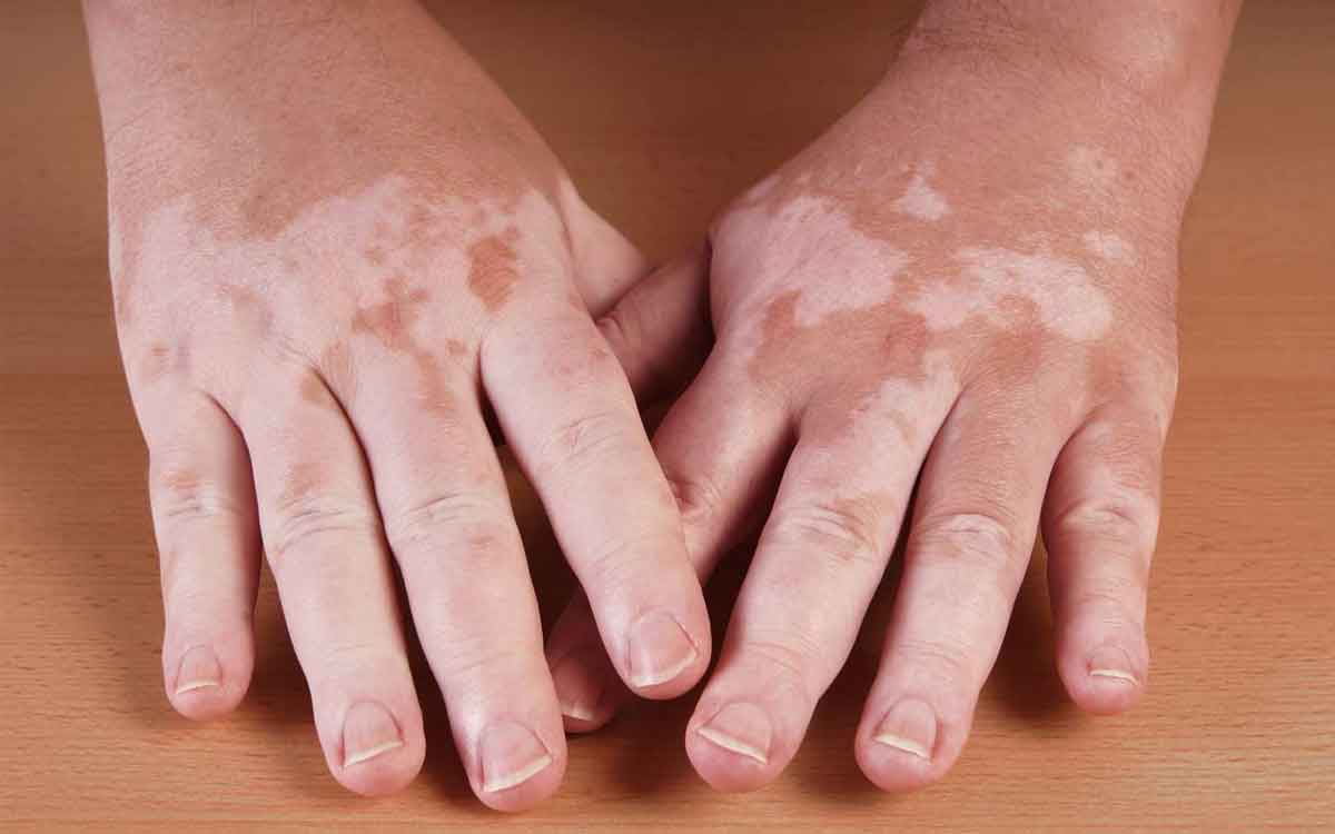 Vitiligo | బొల్లి అంటువ్యాధా.. ఇది ఎలా వ్యాప్తి చెందుతుంది.. కార‌ణాలేంటి..?