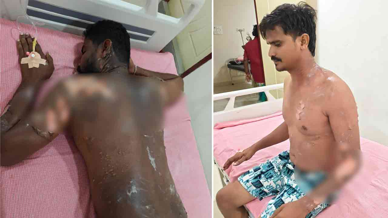 Bhadadri Kothagudem | అప్పారావుపేట పామాయిల్ ఫ్యాక్టరీలో ప్రమాదం… ఇద్దరికీ గాయాలు