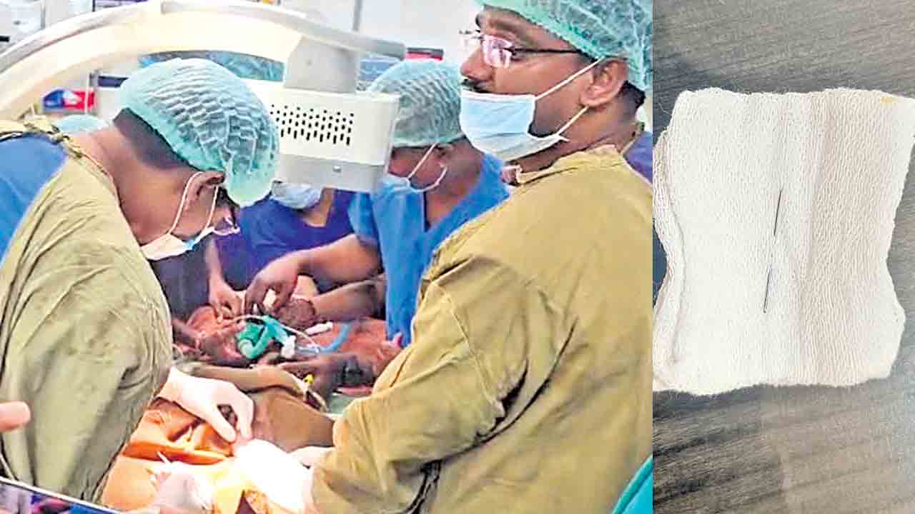 శిశువు తొడలో ఇరుక్కున్న సూది తొలగింపు.. నెలరోజుల నరకయాతనకు తెర