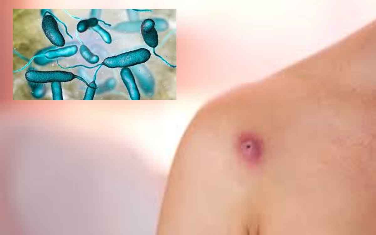 Bacteria | గాయాలు అయిన వారు ఇలాంటి నీటిలోకి దిగితే ప్ర‌మాద‌కరం.. మాంసాన్ని తినే బ్యాక్టీరియా వ్యాపిస్తుంది..