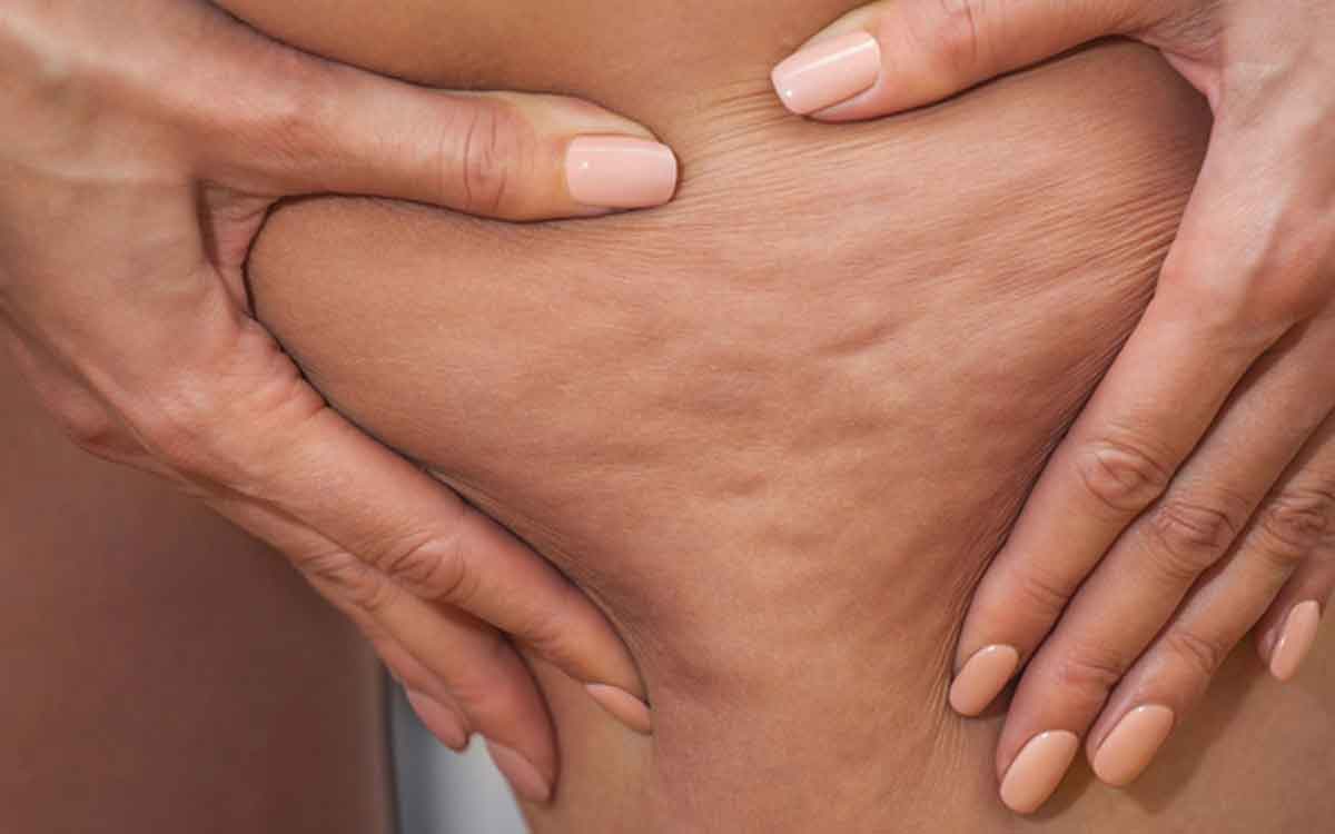 Cellulite | సెల్యులైట్ అంటే ఏమిటి.. ఇది ఎవ‌రికి వ‌స్తుంది.. త‌గ్గాలంటే ఏం చేయాలి..?