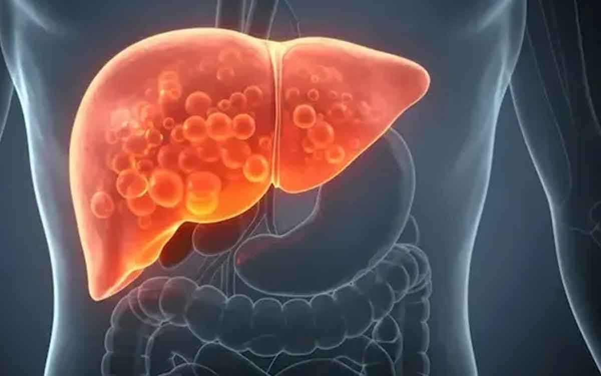 Fatty Liver | ఫ్యాటీ లివర్ స‌మ‌స్య ఉన్న‌వారికి ఎంతో మేలు చేసే వాకింగ్‌.. ఎలా ప‌నిచేస్తుందంటే..