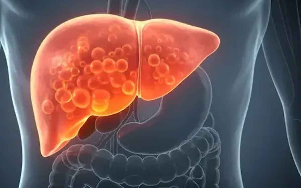 Fatty Liver | ఫ్యాటీ లివ‌ర్ స‌మ‌స్య ఉన్న‌వారు పాటించాల్సిన డైట్ ఇదే.. దీంతో లివ‌ర్‌కు ఎంతో మేలు..