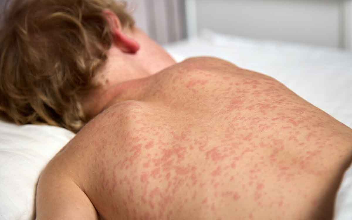 Vaccine | ప్రపంచాన్ని మళ్లీ వణికిస్తున్న మీజిల్స్.. టీకాలే రక్షణ..