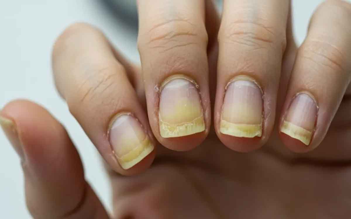 Nails | గోర్ల‌లో ఈ ల‌క్ష‌ణాలు క‌నిపిస్తే జాగ్ర‌త్త‌.. నిర్ల‌క్ష్యం చేయ‌కండి..