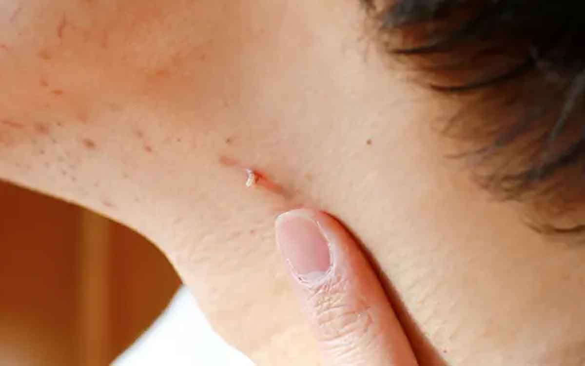 Warts | పులిపిర్ల‌ను త‌గ్గించే ఇంటి చిట్కాలు.. ఇలా చేస్తే స‌మ‌స్య త‌గ్గుతుంది..