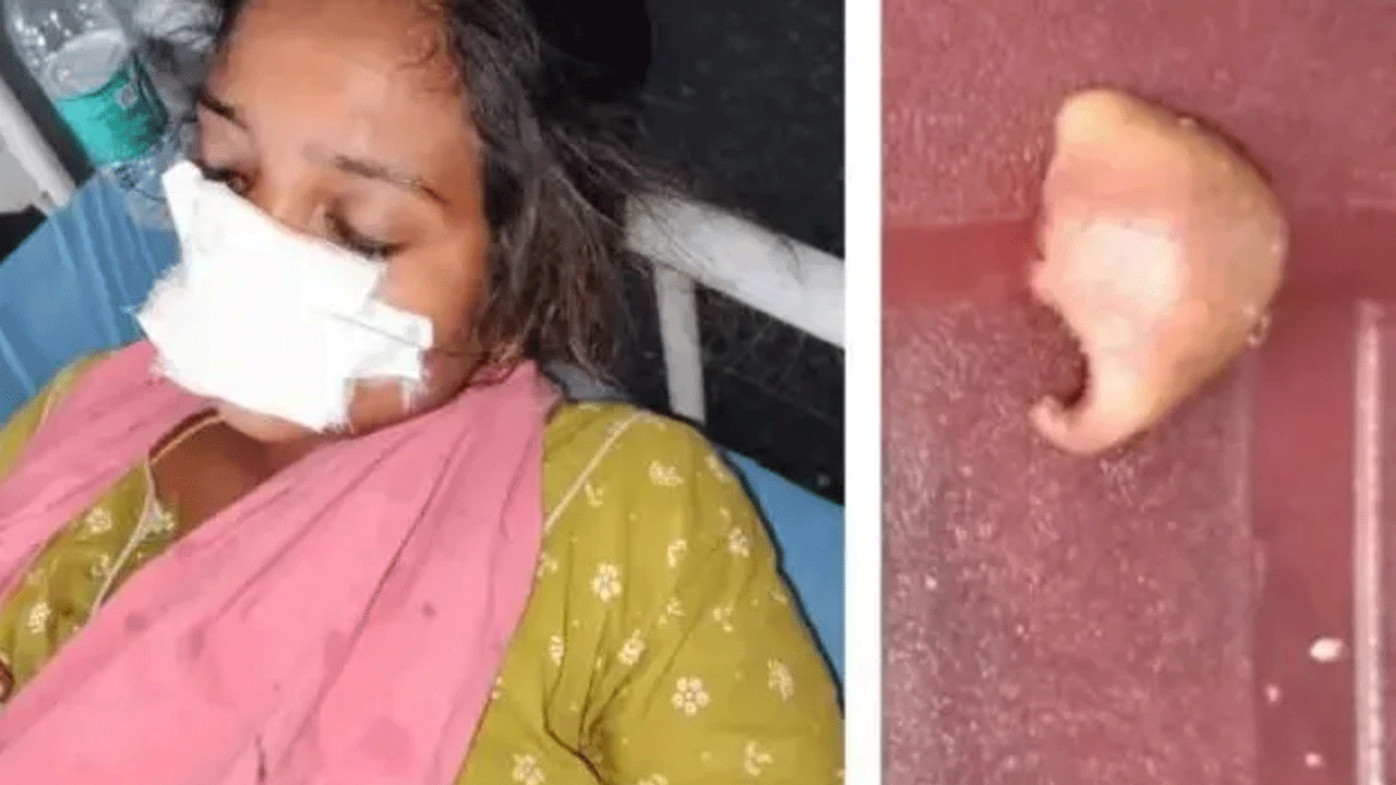 Viral news | కాపురానికి వ‌స్త‌లేద‌న్న క‌క్ష‌తో అత్తగారింటికాడ భార్య ముక్కు కొరికేసిన భ‌ర్త‌..!