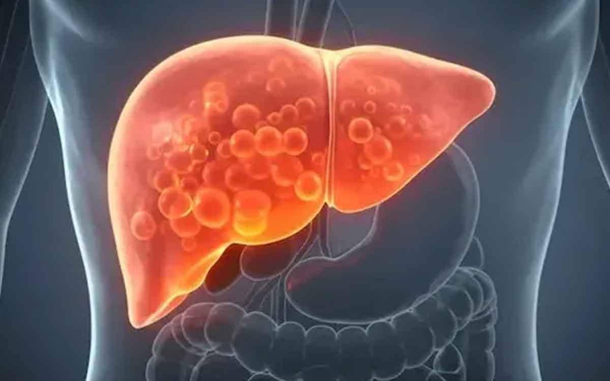 Fatty Liver | గ్రేడ్‌-1 ఫ్యాటీ లివర్‌ ఉంటే టీ ఎలా తాగాలి?