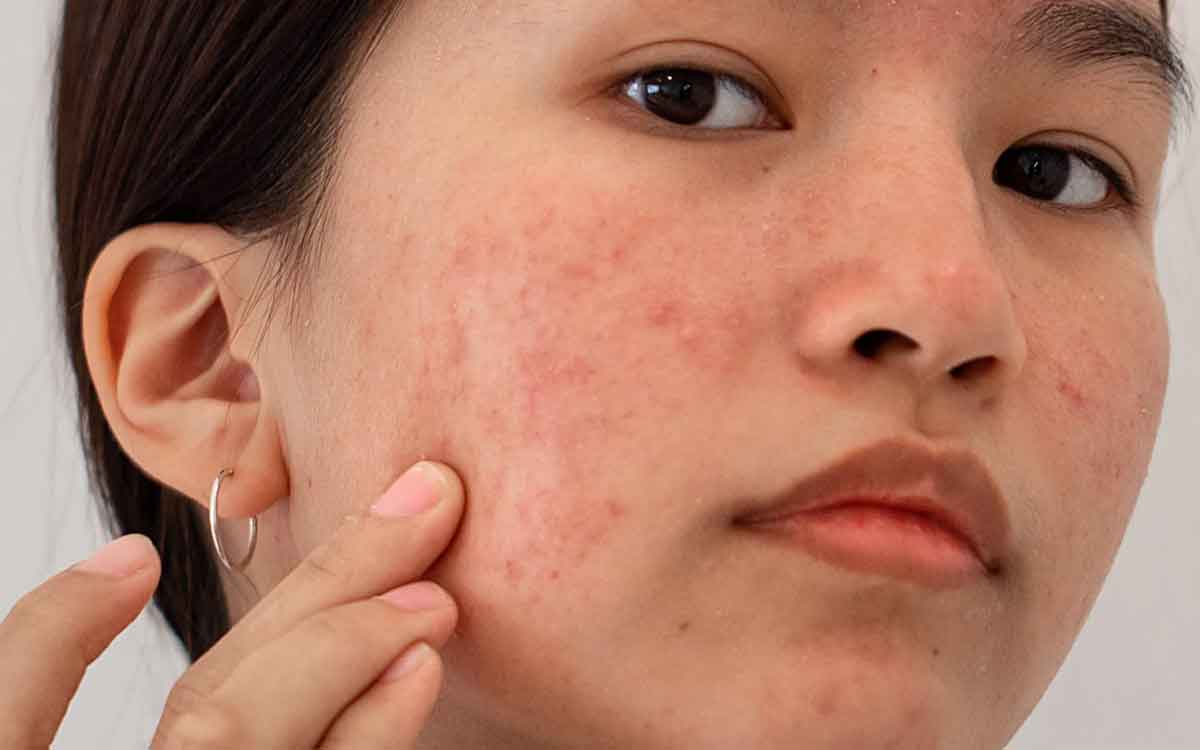 PCOS | పీసీవోఎస్ స‌మ‌స్య నుంచి బ‌య‌ట ప‌డేదెలా.. వైద్యులు ఏం ప‌రిష్కారం చెబుతున్నారు..?