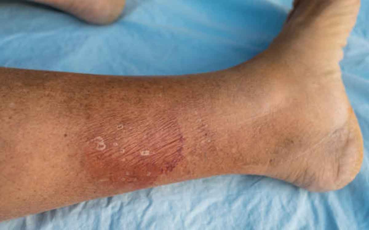 Sepsis | సెప్సిస్ అంటే ఏమిటి.. మూత్రాశయ ఇన్ఫెక్షన్ ఉంటే సెప్సిస్ వస్తుందా.. Sepsis | సెప్సిస్ అంటే ఏమిటి.. మూత్రాశయ ఇన్ఫెక్షన్ ఉంటే సెప్సిస్ వస్తుందా..