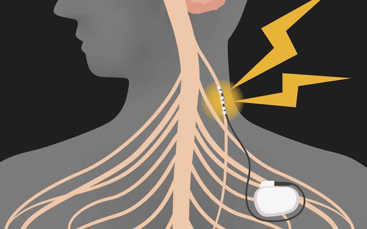 Vagus Nerve | వేగ‌స్ నాడిని ఉత్తేజ ప‌రిచే అధునాత‌న ప‌రిక‌రాలు.. చ‌ర్మం నుంచే నాడికి ఉత్తేజం..