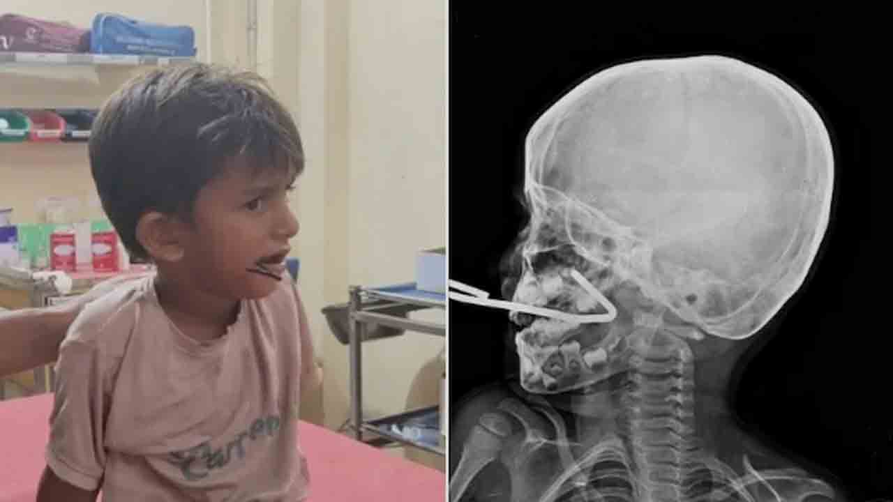 Iron Rod Pierces Boy’s Mouth | ఆడుతూ కిందపడిన బాలుడు.. నోటిలోకి చొచ్చుకెళ్లిన ఇనుప కడ్డీ