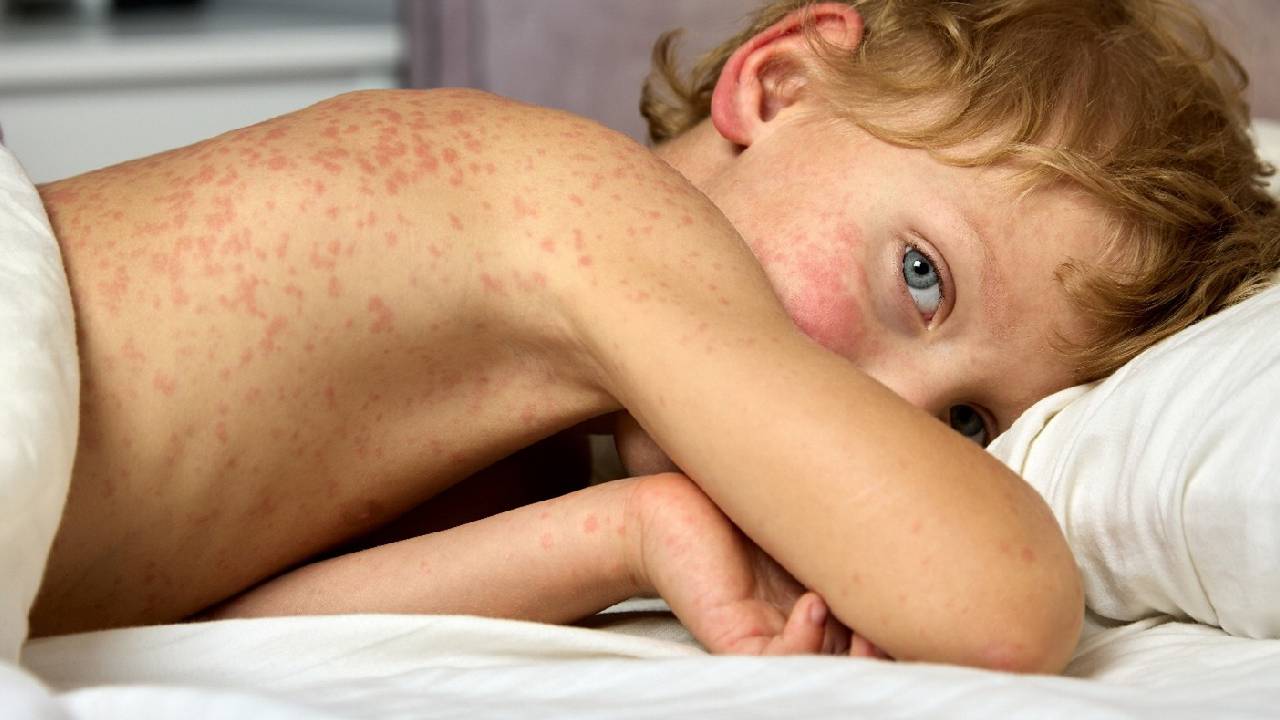 Measles Cases | అమెరికాలో విజృంభిస్తున్న మీజిల్స్.. పెన్సిల్వేనియాలో 1,000 దాటిన కేసులు