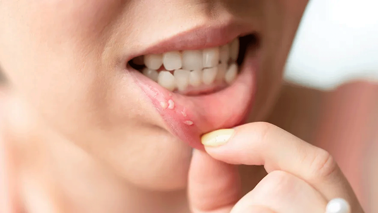 Health tips | నోటి పుండ్లు మిమ్మల్ని వేధిస్తున్నాయా.. అయితే ఈ సింపుల్‌ టిప్స్‌ మీ కోసమే..!