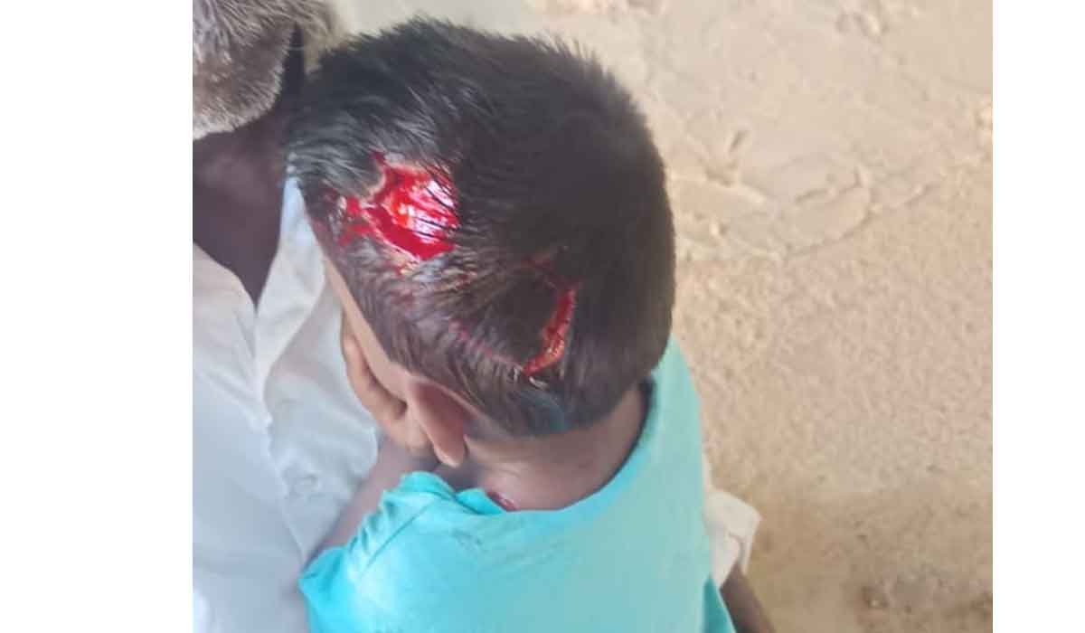 Nagireddypet | అక్కంపల్లిలో వీధి కుక్కల దాడి… చిన్నారికి తీవ్ర గాయాలు