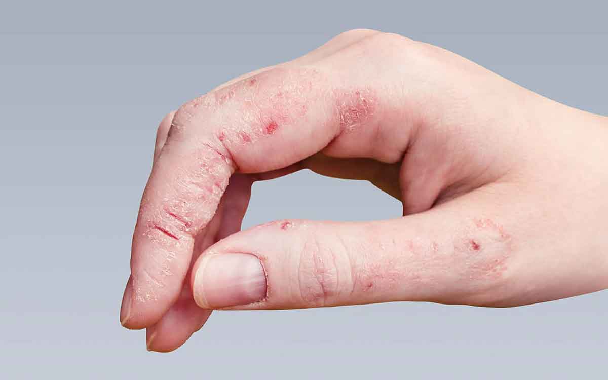 Fungus Infections | క్యాన్స‌ర్ లేదా అవ‌య‌వ మార్పిడి పేషెంట్ల‌కు ఫంగ‌స్ ఇన్‌ఫెక్ష‌న్లు ఎందుకు ప్రమాద‌క‌రం అవుతాయి..?