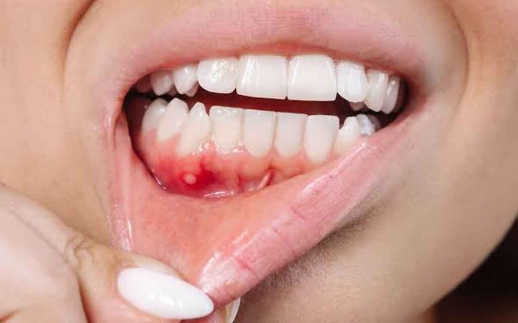 Mouth Cancer | నోటి ఆరోగ్యం సరిగ్గా లేకపోతే నోటి క్యాన్సర్ వస్తుందా.. ఇతర కారణాలు ఉన్నాయా..?