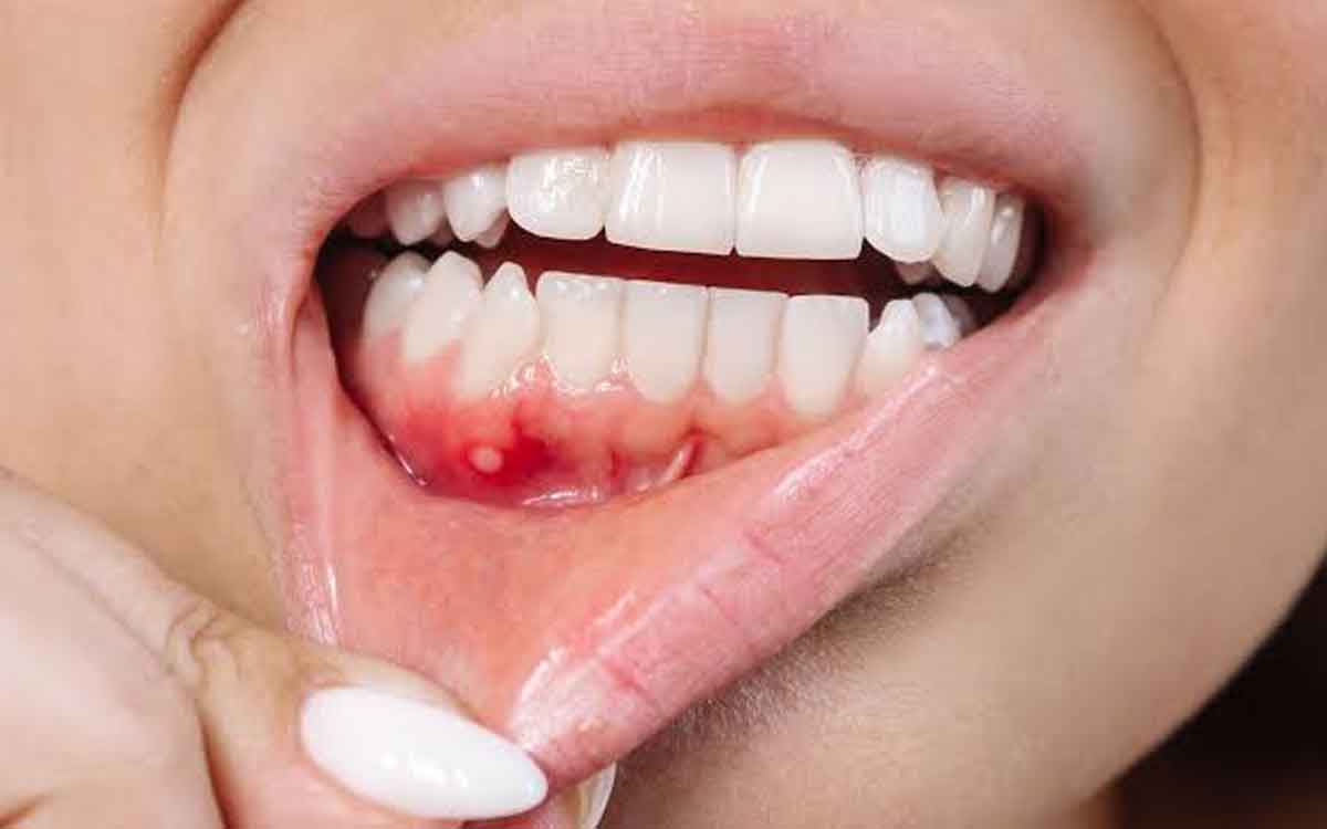 Mouth Cancer | నోటి ఆరోగ్యం స‌రిగ్గా లేక‌పోతే నోటి క్యాన్స‌ర్ వ‌స్తుందా.. ఇత‌ర కార‌ణాలు ఉన్నాయా..?
