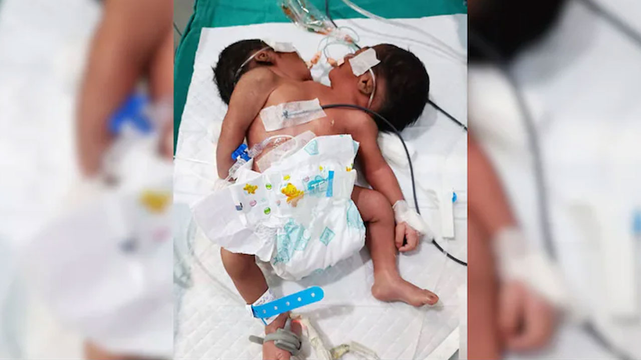 Congenital Birth: ఒడిశాలో రెండు త‌ల‌లతో పుట్టిన మ‌గ శిశువు